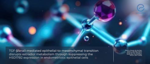 How Epithelial-to-Mesenchymal Transition  Alters Estradiol Metabolism in Endometriotic Cells?