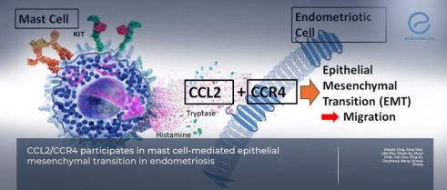 Mast Cell–Mediated Epithelial–Mesenchymal Transition in Endometriosis