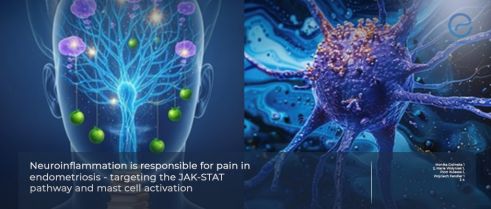 How Neuroinflammation Sensitizes Pain Pathways in Endometriosis