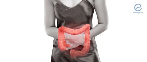Surgical treatment of colonic endometriosis