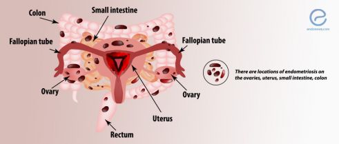 Atypical Sites of Deeply Infiltrative Endometriosis