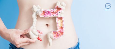 Intestinal Endometriosis and Colorectal Cancer versus T4 Colorectal Cancer