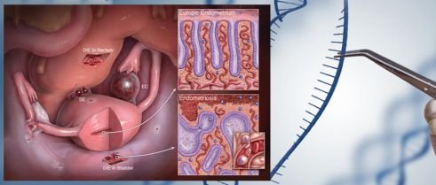 Independent development of endometrial epithelium and stroma within the same endometriosis