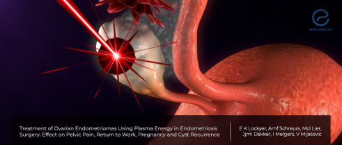 Plasma Energy for Ovarian Endometriomas