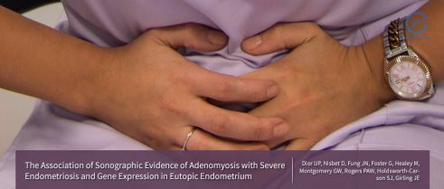 What clinicians know about adenomyosis? Any association with severe endometriosis?