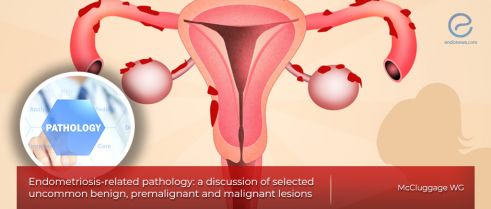 Rare lesions in the pathologic examinations of endometriosis.