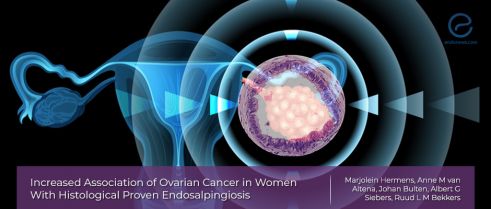 The link between ovarian cancer and endosalpingiosis