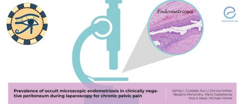 Occult microscopic endometriosis in clinically negative peritoneum 