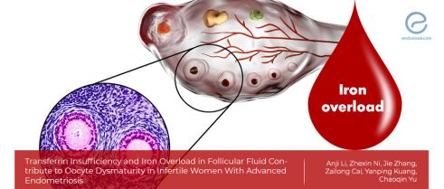 Iron overload in follicular fluid in Endometriosis