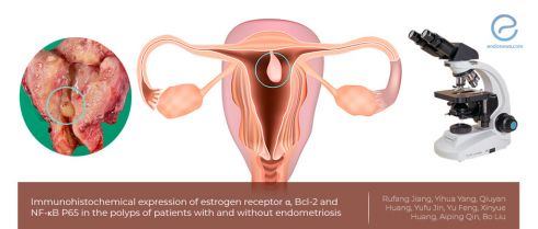 Endometrial polyps of patients with and without endometriosis 