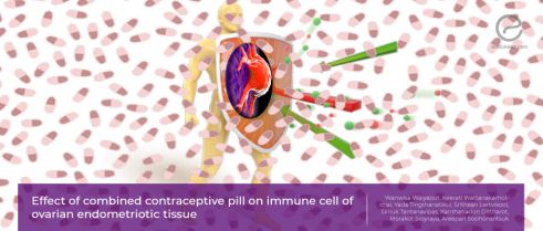 Combined contraceptive pills and immune system cells in the endometriotic cyst wall