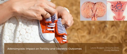 Adenomyosis, fertility, and obstetric outcomes