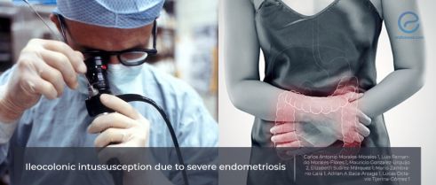 A rare complication of  endometriosis