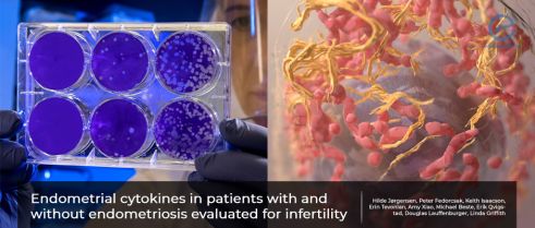 The Role of Endometrial Cytokines on the Infertility in Endometriosis Patients