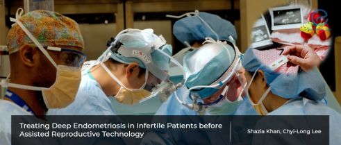 Surgery before in-vitro fertilization – Is it beneficial in patients with deep endometriosis?