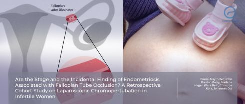 Fallopian tube occlusion in infertile women with endometriosis