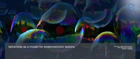 Spheroids: 3D-mini-models for Understanding Endometriosis