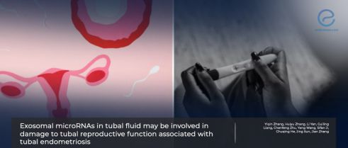 Study May Explain How Tubal Endometriosis Causes Infertility