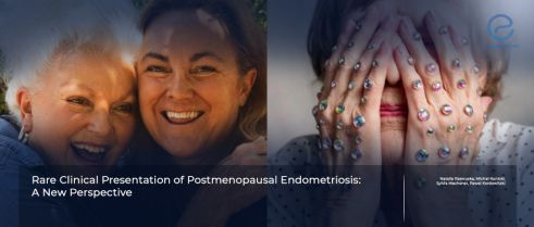 Diagnosis and the Treatment of Postmenopausal Endometriosis