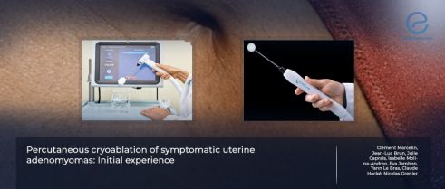 Management of uterine adenomyomas with percutaneous cryoablation.