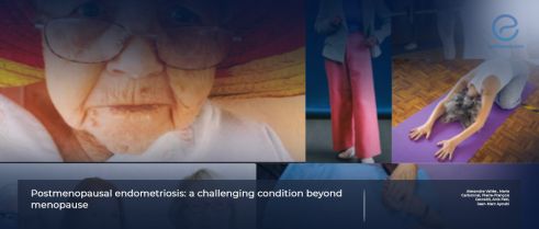 A literature review about postmenopausal endometriosis.