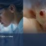 Uncovering a New Molecular Driver in Endometriosis