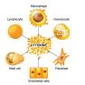 Immune substances in peritoneal fluid for endometriosis diagnosis and armamentarium