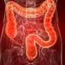 Bowel Involvement in Deep Infiltrating Endometriosis