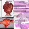 Ovarian Endometriomas vs Deep Infiltrating Endometriosis