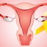 Updates in the Field of Endometriosis
