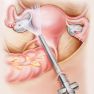 Cohort study on outcomes of laparoscopic endometriosis surgery