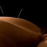 Effects of acupuncture for the treatment of endometriosis-related pain