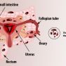 Atypical Sites of Deeply Infiltrative Endometriosis