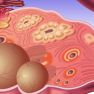 Benign Gynecological Tumors in Women with Endometriosis