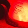 Using near-infrared imaging to discriminate malignant from benign endometriosis 