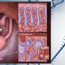 Independent development of endometrial epithelium and stroma within the same endometriosis