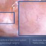 Picture This: 8K UHD Television System for Endometriosis Surgery