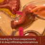 Laparoscopic surgery of endometriosis through three compartments 