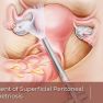 Endometriosis involving the superficial peritoneum in Adolescents: Surgical Management