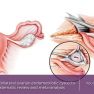 Antimullerian Hormone, endometrioma and ovarian reserve