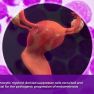Importance of monocytic myeloid derived supressor cells in endometriosis