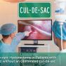 Is there any difference between endometriosis patients with or without obliterated cul-de-sac during laparoscopic hysterectomy?