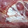 Thoracic endometriosis: the most frequent endometriosis involvement outside abdominopelvic cavity