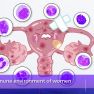 Immune environment of endometriosis