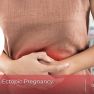 The association between endometriosis and ectopic pregnancy