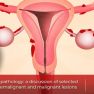 Rare lesions in the pathologic examinations of endometriosis.