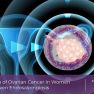 The link between ovarian cancer and endosalpingiosis