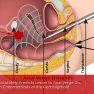 Transvaginal sonography for predicting the distance between rectosigmoid endometriosis and the anal verge