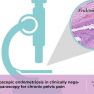 Occult microscopic endometriosis in clinically negative peritoneum 