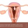 Endometrial polyps of patients with and without endometriosis 